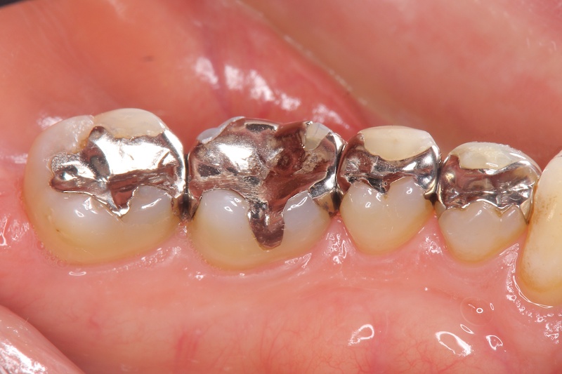 銀歯の治療