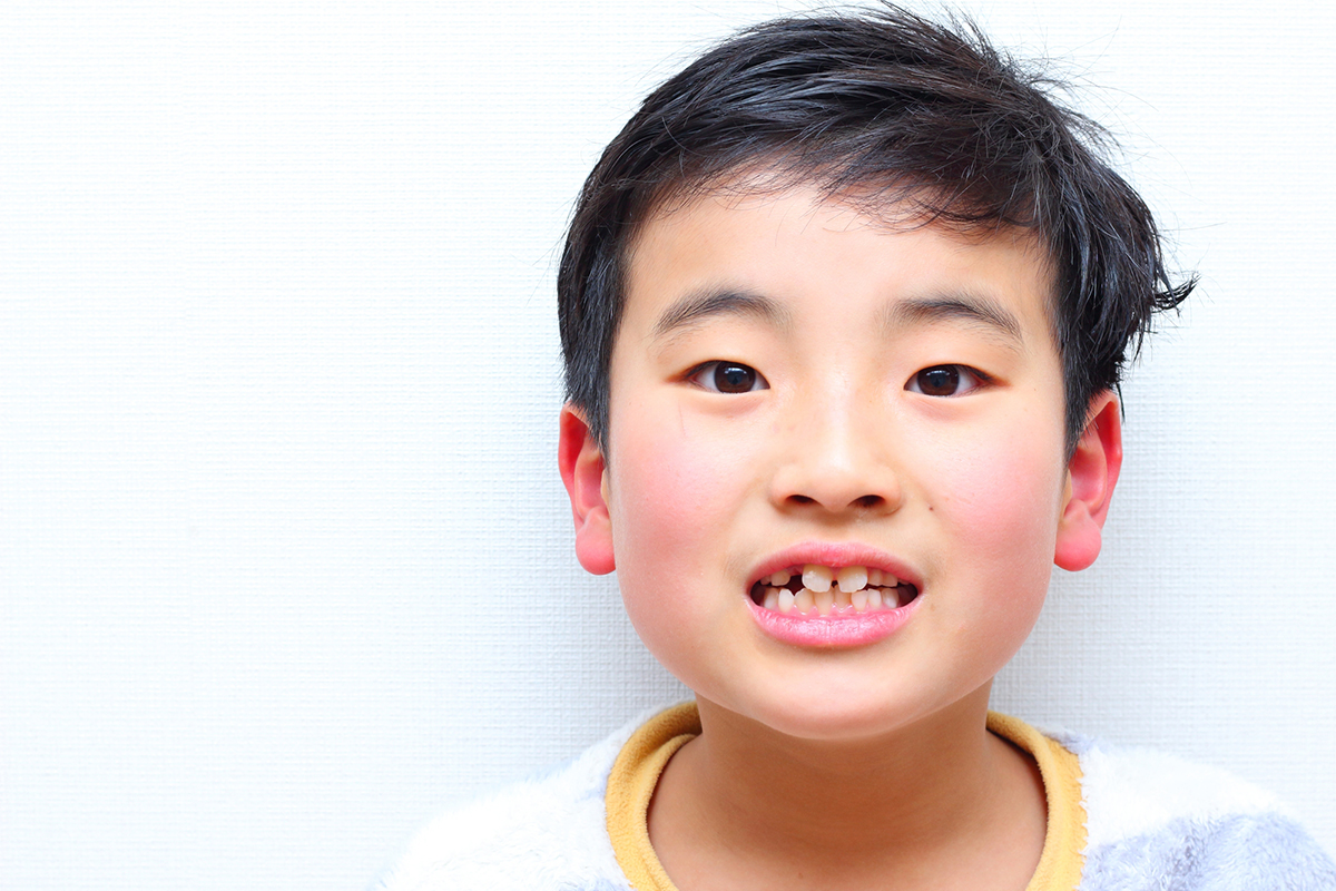 前歯の歯並びの子供の口元