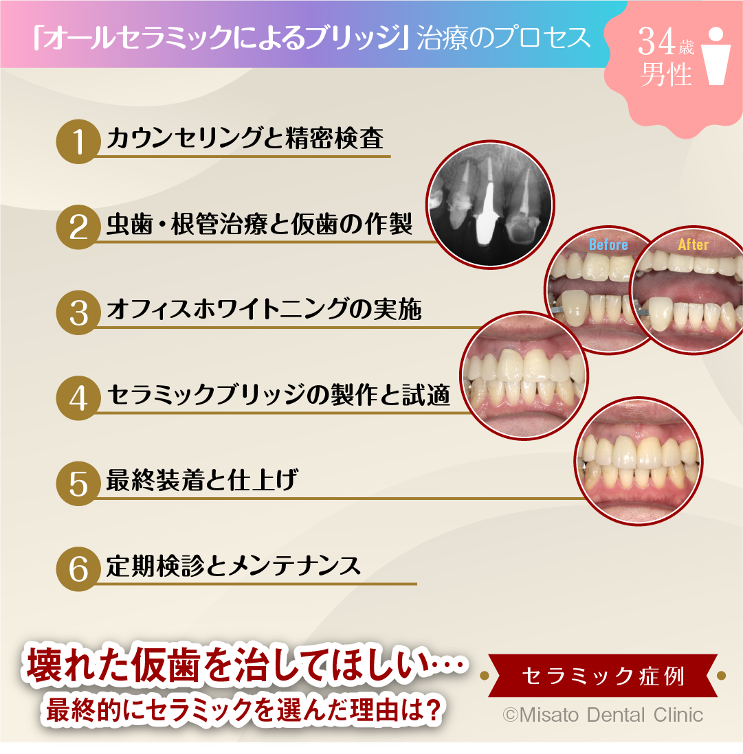 「オールセラミックによるブリッジ」治療のプロセス