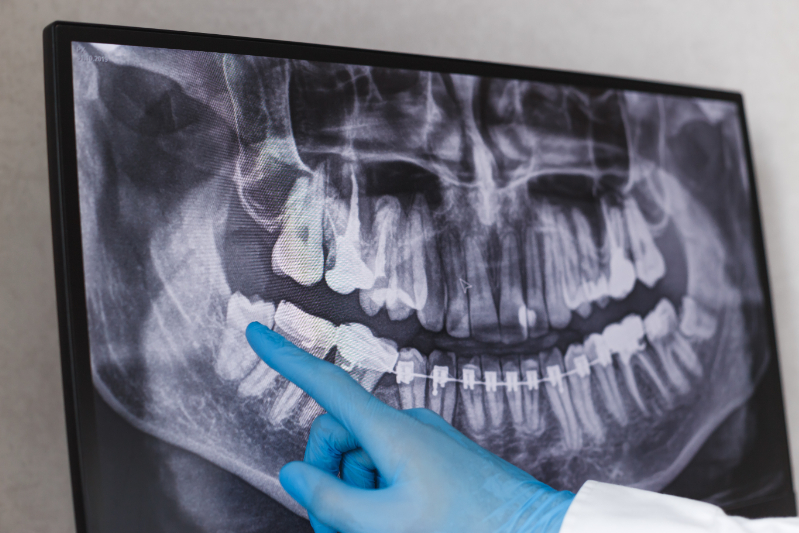 歯周病治療のためにレントゲンで骨の状態を確認する様子