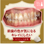 前歯の色が気になるキレイにしたい