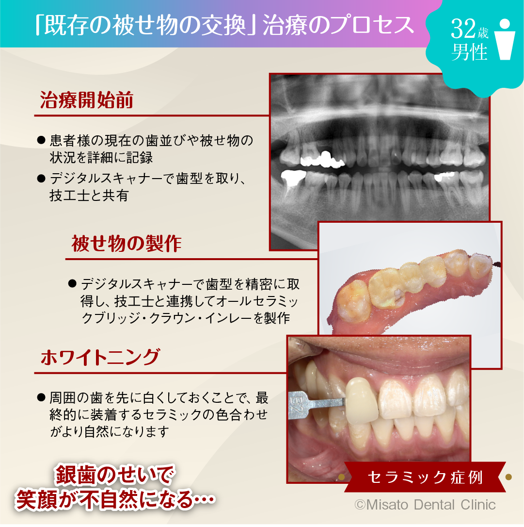 「既存の被せ物の交換」治療のプロセス