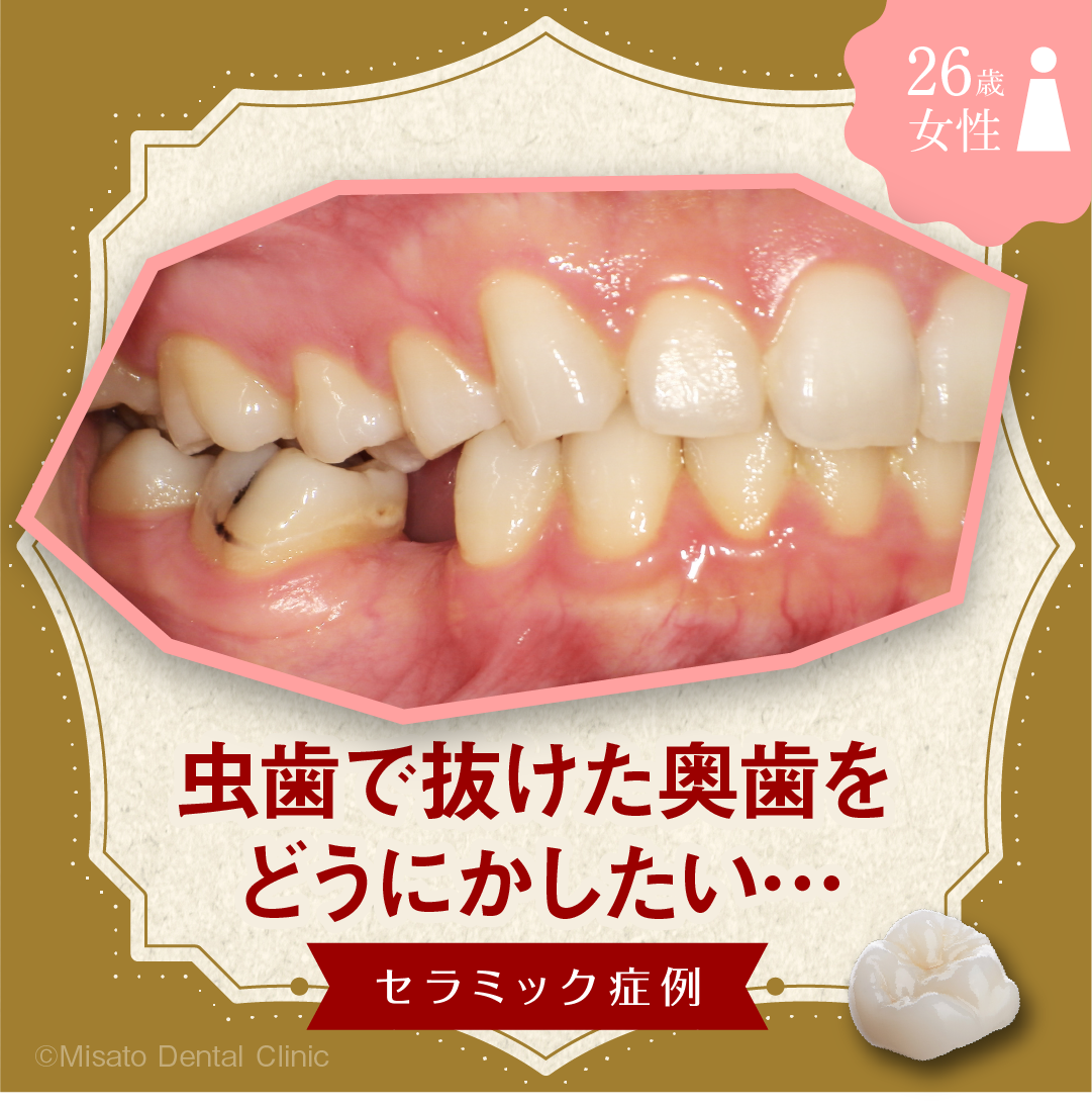 虫歯で抜けた奥歯をどうにかしたいセラミック症例