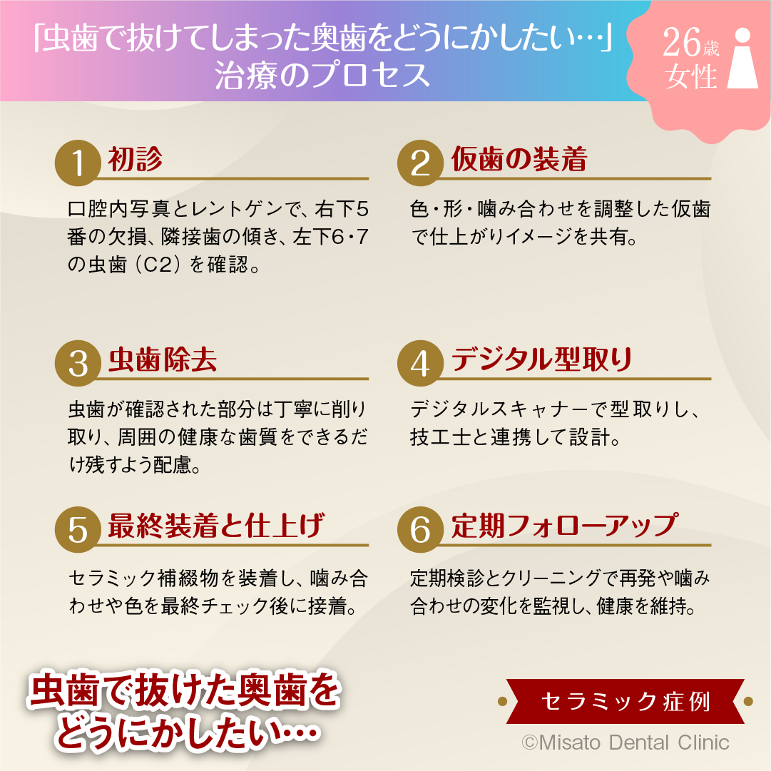 「虫歯で抜けてしまった奥歯をどうにかしたい…」治療のプロセス