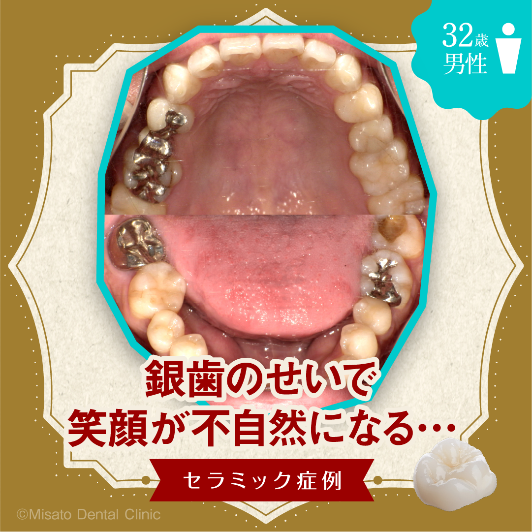 銀歯のせいで笑顔が不自然になるセラミック症例