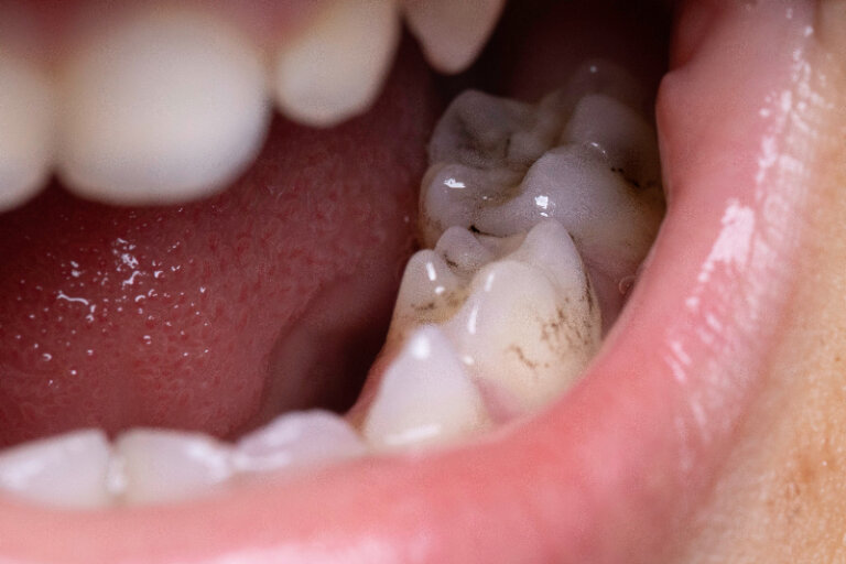 歯が黒いのは虫歯？確認する方法と治療法も