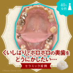 くいしばりでボロボロの奥歯をどうにかしたいセラミック症例