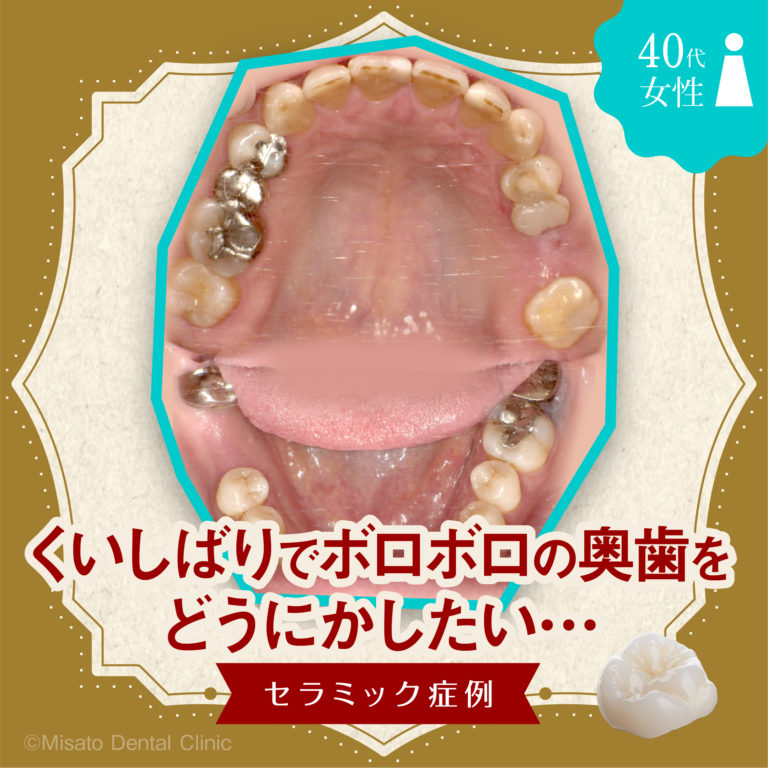 「くいしばりでだめになってしまった奥歯をどうにかしたい…セラミック治療での再生」セラミック症例
