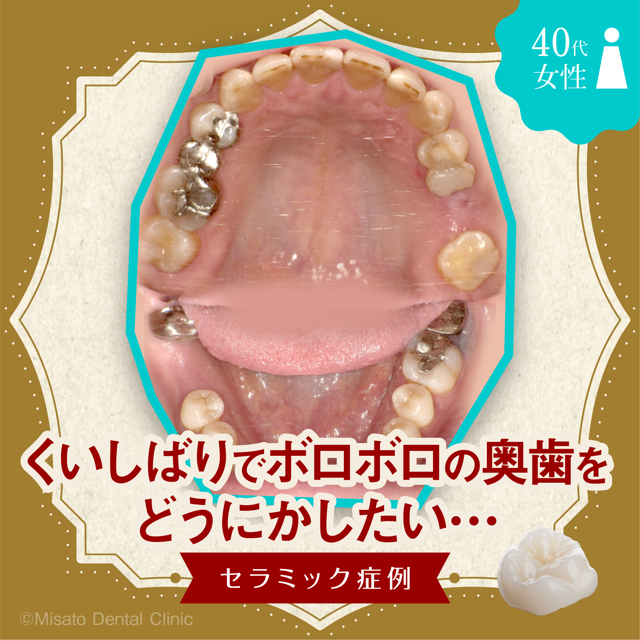 くいしばりでボロボロの奥歯をどうにかしたいセラミック症例