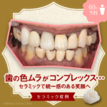 歯の色ムラがコンプレックス…セラミックで統一感のある笑顔へ」セラミック症例