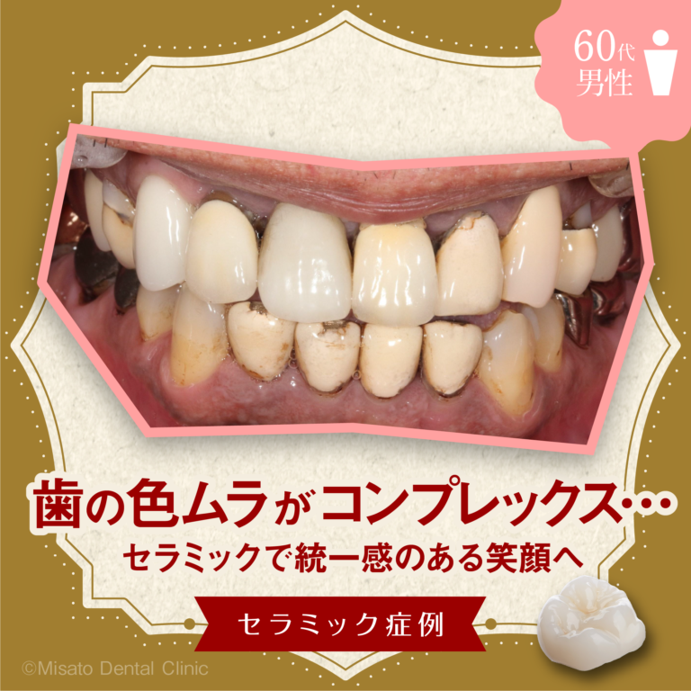 「歯の色ムラがコンプレックス…セラミックで統一感のある笑顔へ」セラミック症例