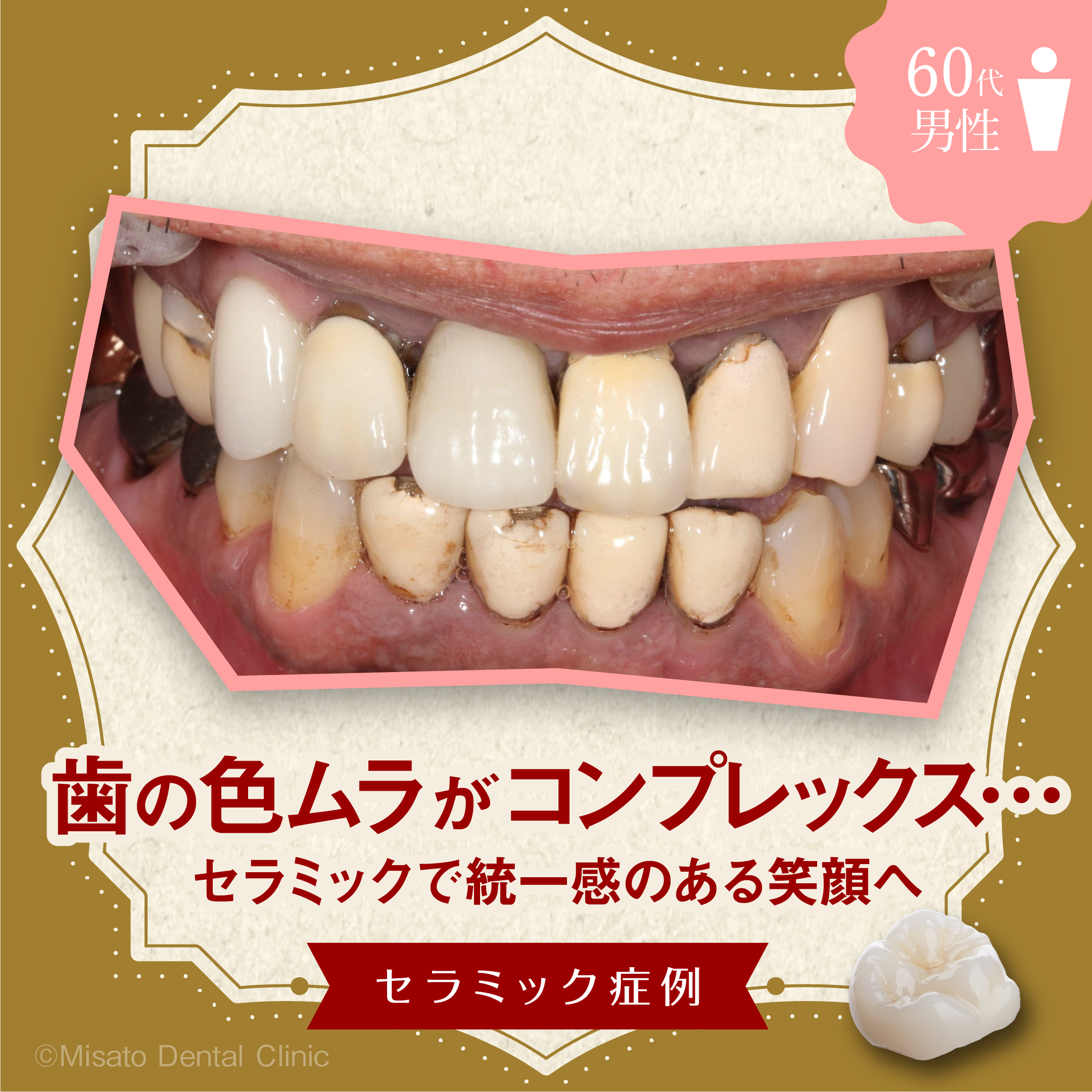 歯の色ムラがコンプレックス…セラミックで統一感のある笑顔へ」セラミック症例