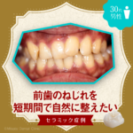前歯のねじれを 短期間で自然に整えたい