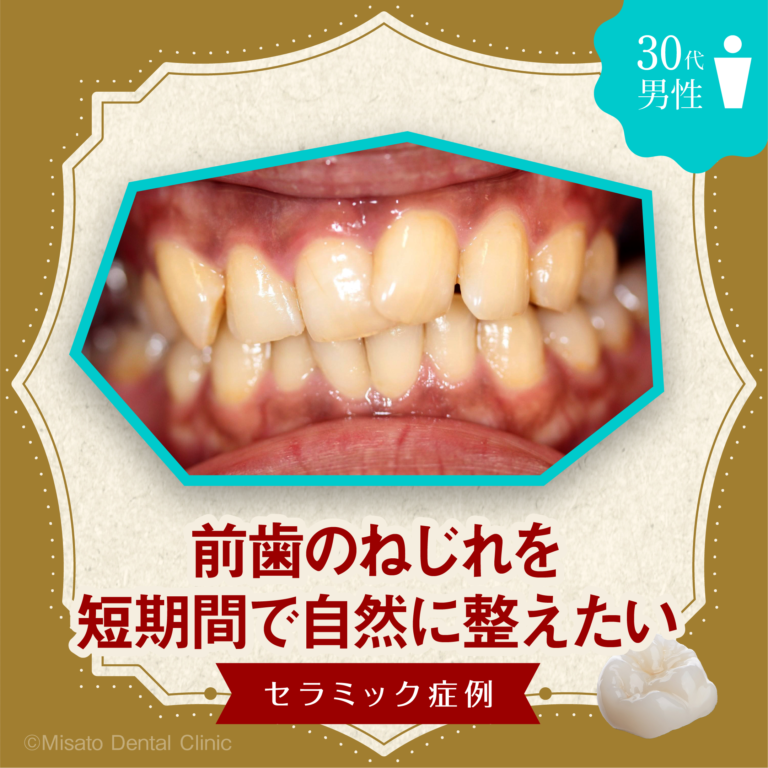 「前歯のねじれを 短期間で自然に整えたい」セラミック症例