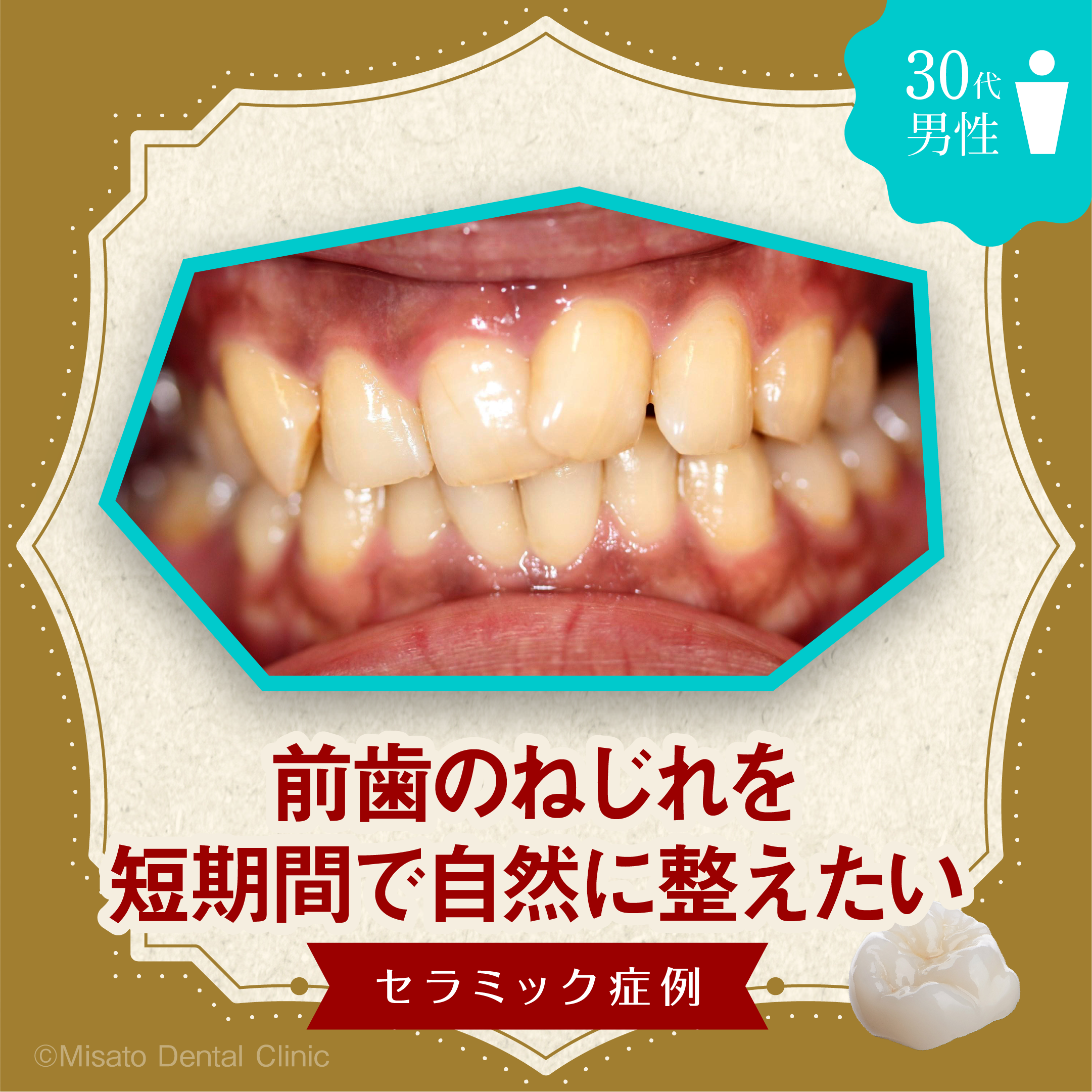 前歯のねじれを 短期間で自然に整えたい