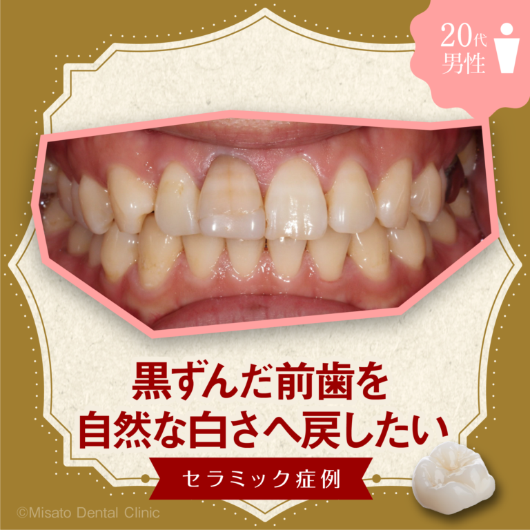 「黒ずんだ前歯を自然な白さへ戻したい」セラミック症例
