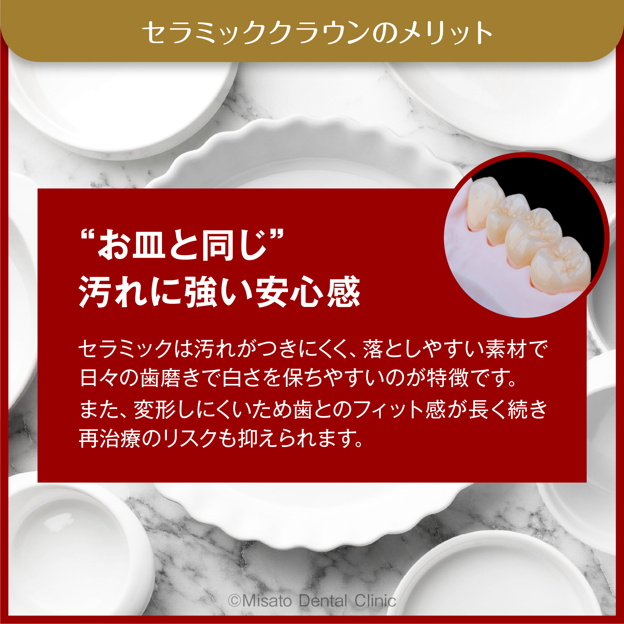 セラミッククラウンのメリット