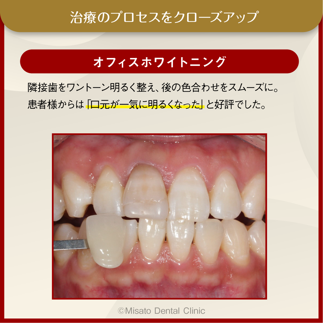 治療のプロセスをクローズアップ_オフィスホワイトニンク