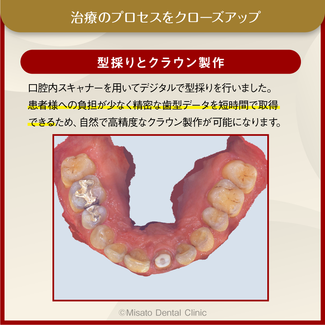 治療のプロセスをクローズアップ_型採りとクラウン製作