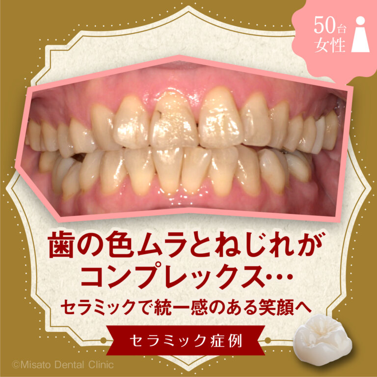 「歯の色ムラとねじれがコンプレックス…セラミックで統一感のある笑顔へ」セラミック症例