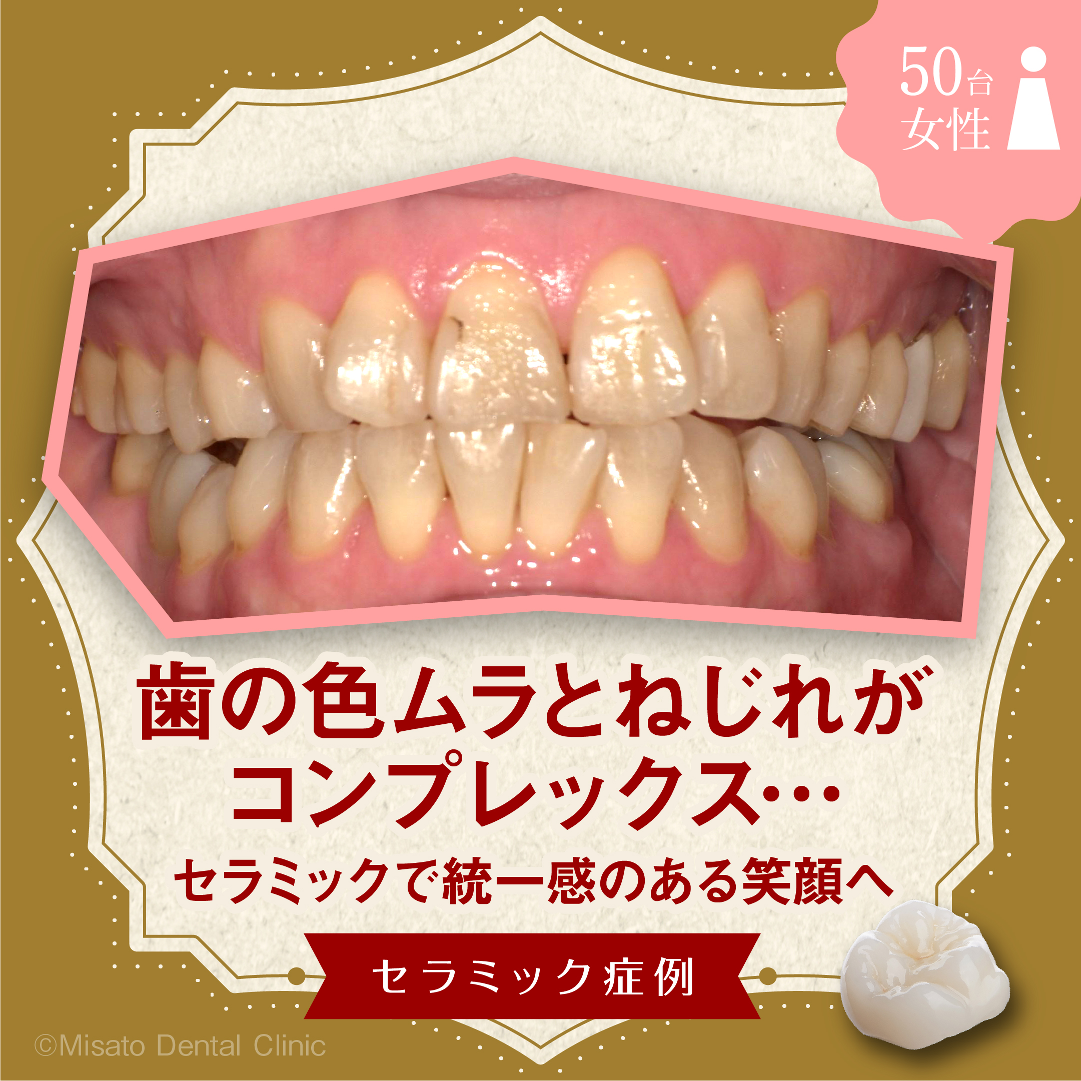 歯の色ムラとねじれがコンプレックス…セラミックで統一感のある笑顔へ