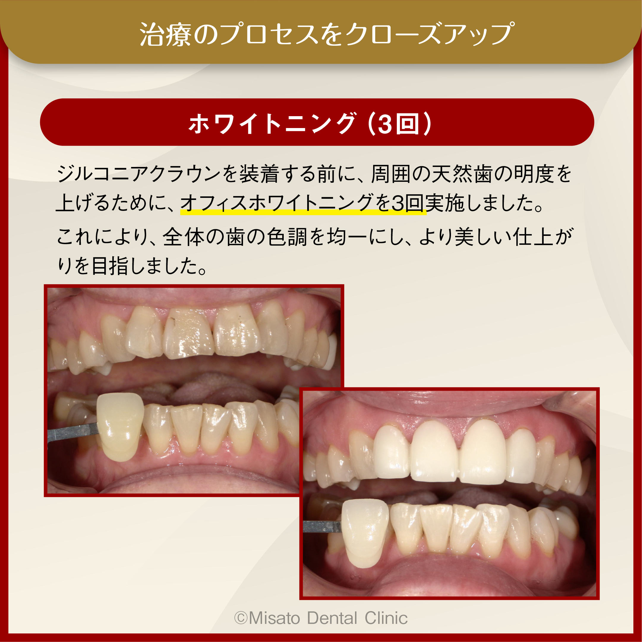 治療のプロセスをクローズアップ_オフィスホワイトニング