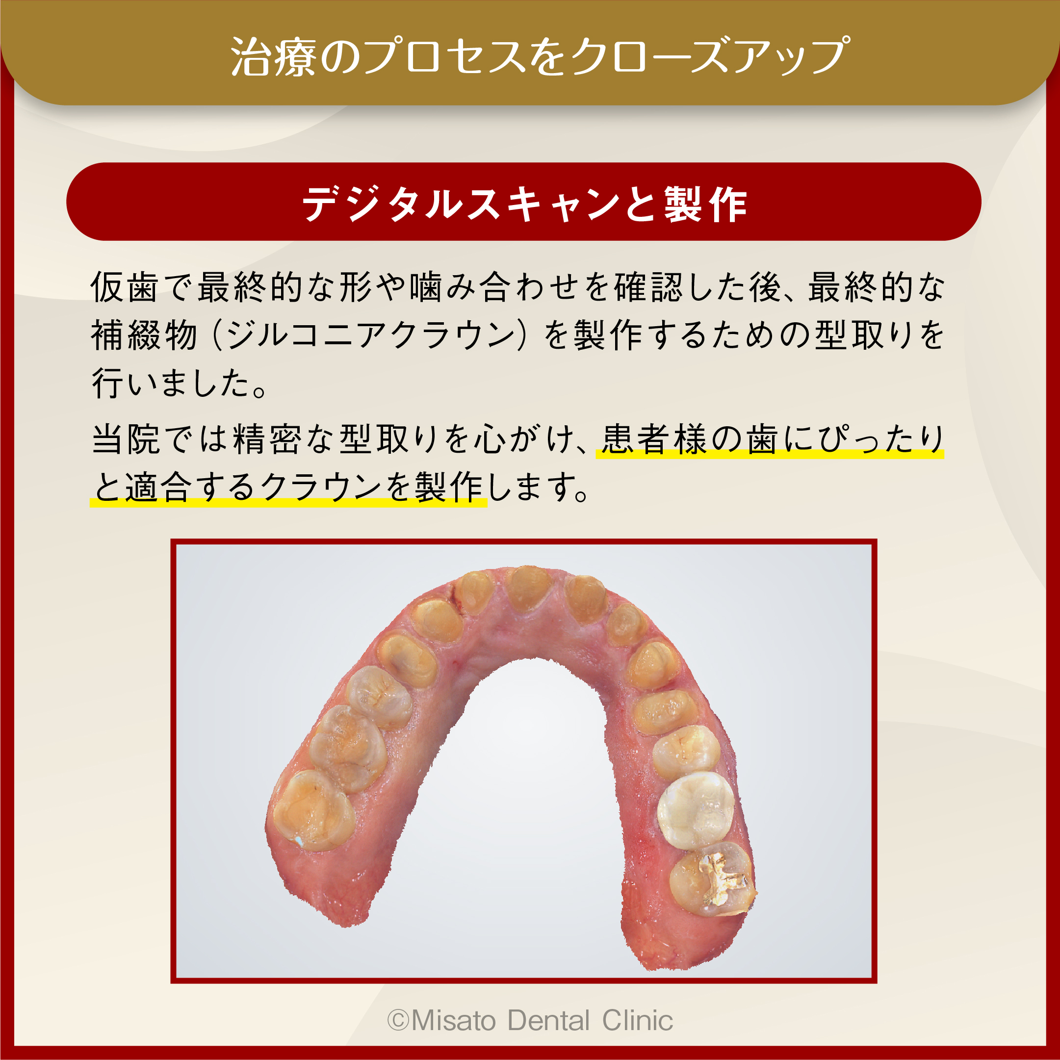 治療のプロセスをクローズアップ_型採りとクラウン製作