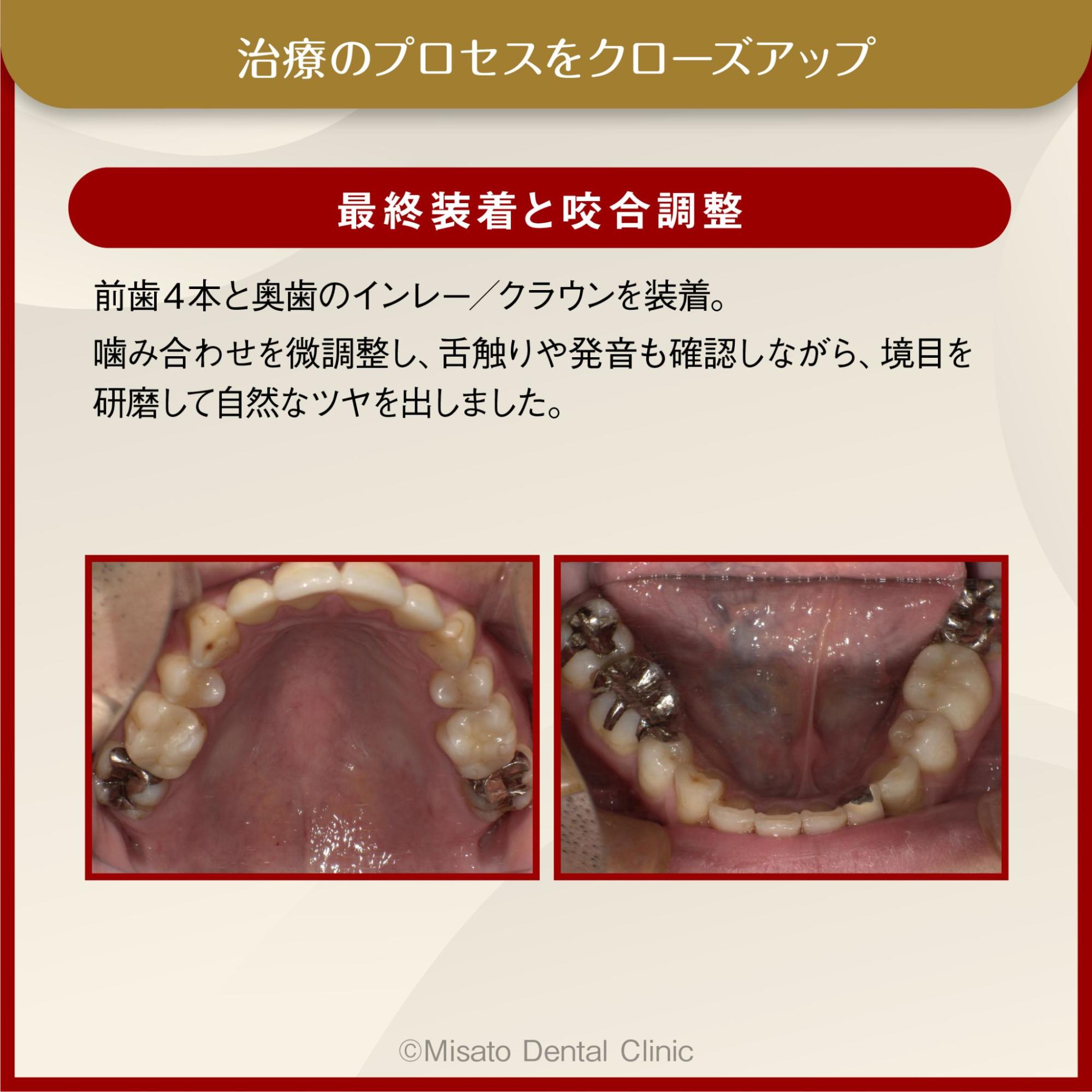 最終装着と咬合調整