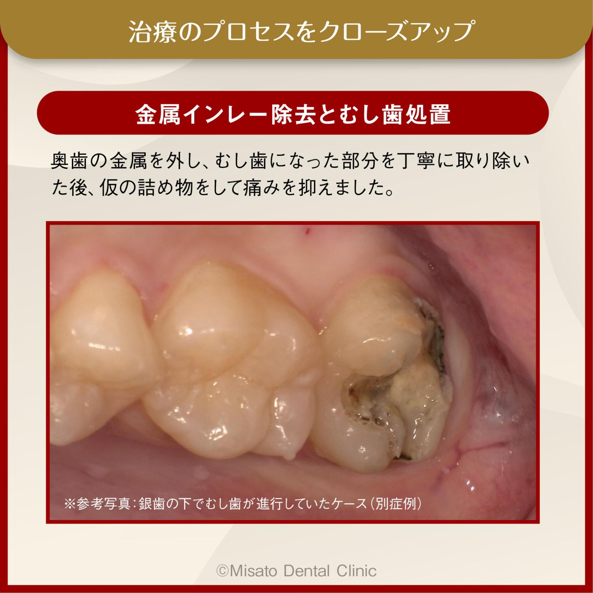 金属インレー除去と虫歯処置