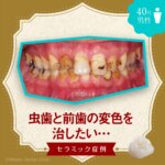 「虫歯と前歯の変色を治したい」セラミック症例