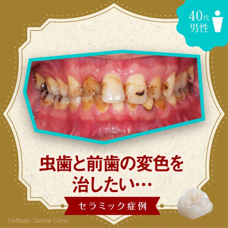 「虫歯と前歯の変色を治したい」セラミック症例