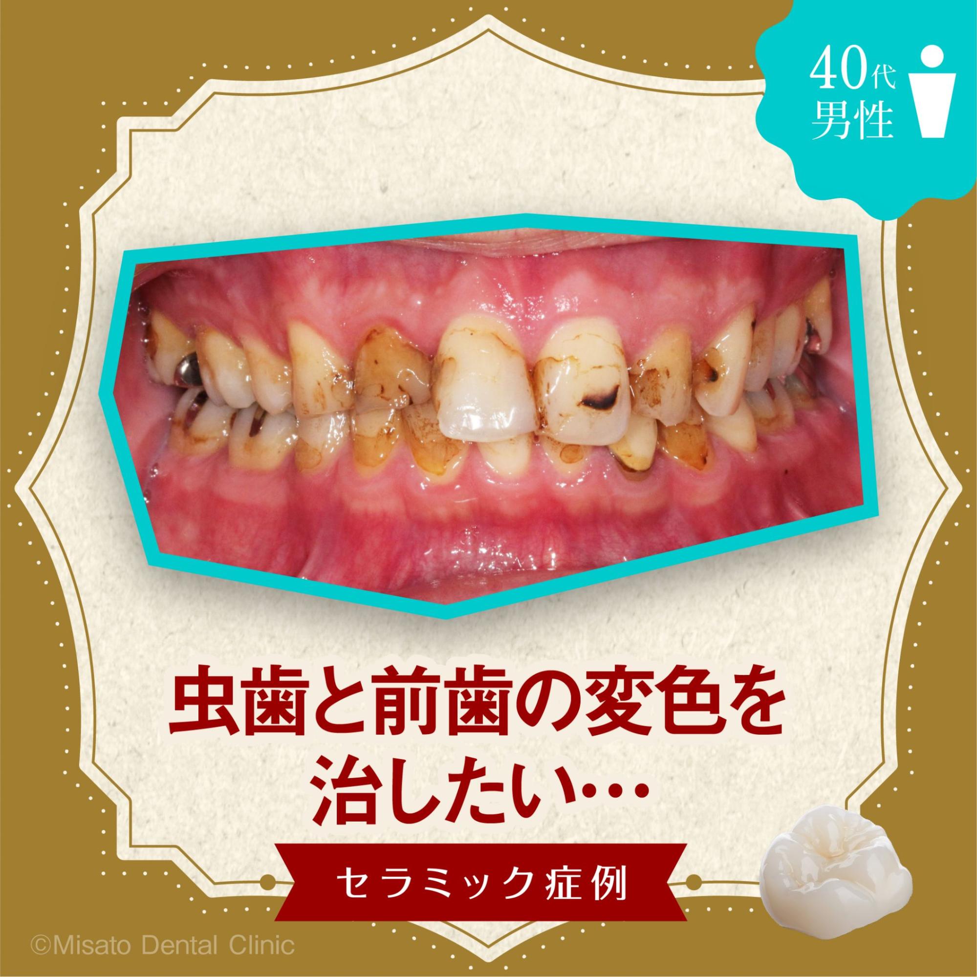「虫歯と前歯の変色を治したい」セラミック症例