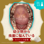 幼少期から?虫歯に悩んでいるセラミック症例