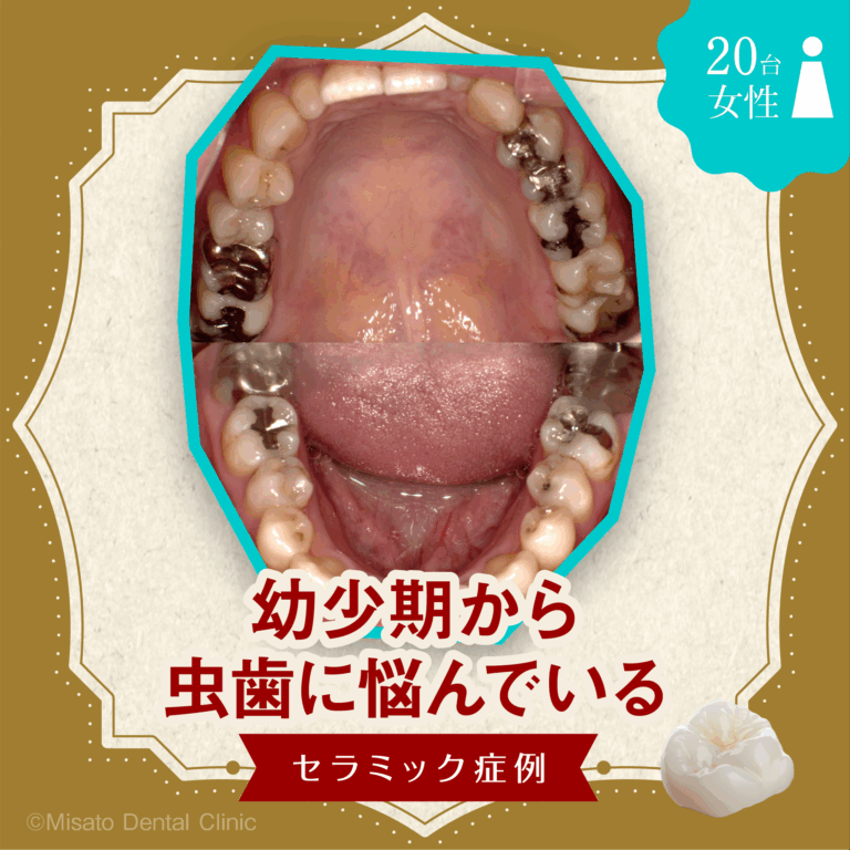 「幼少期から虫歯に悩んでいる」セラミック症例