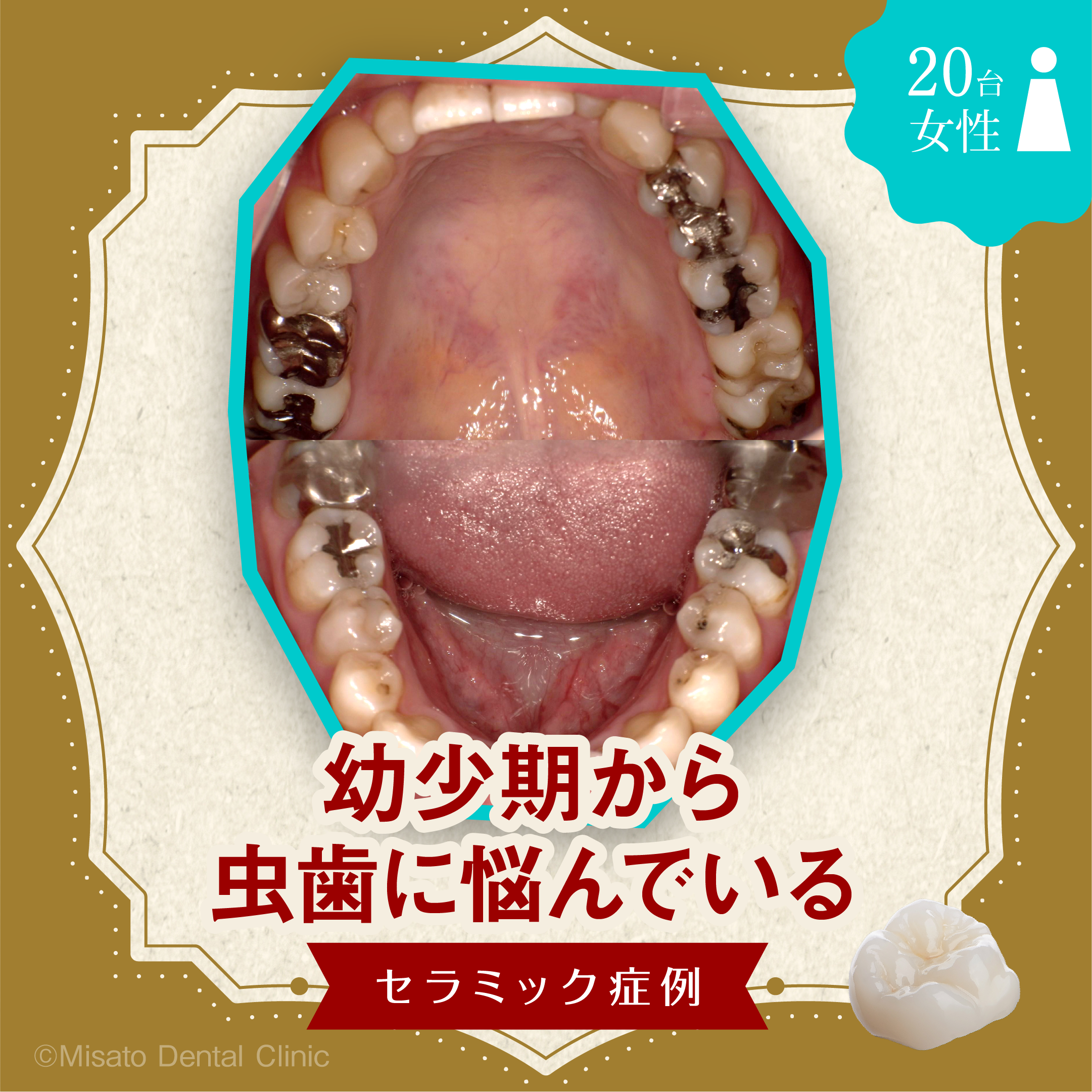 幼少期から?虫歯に悩んでいるセラミック症例