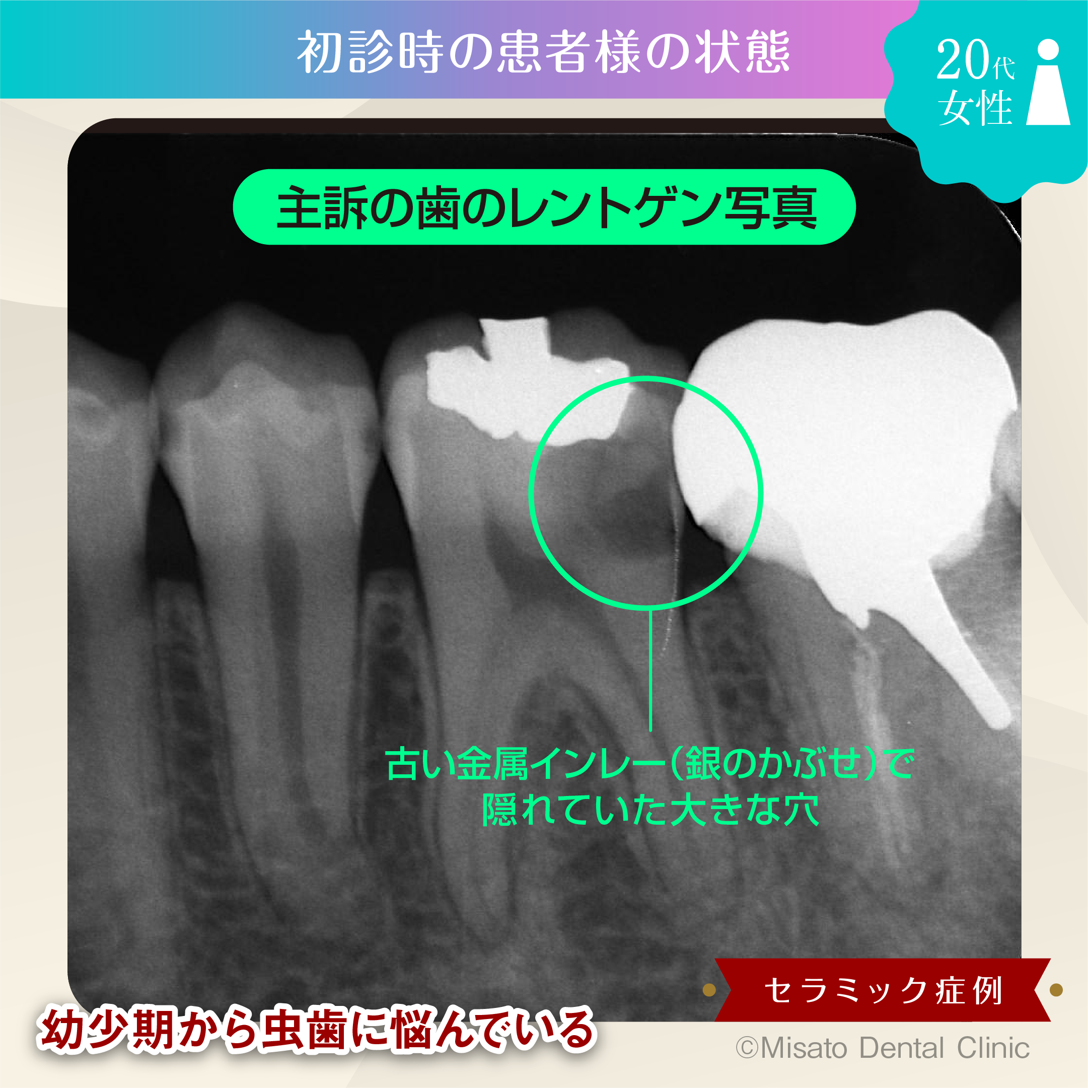 主訴の歯のレントゲン写真