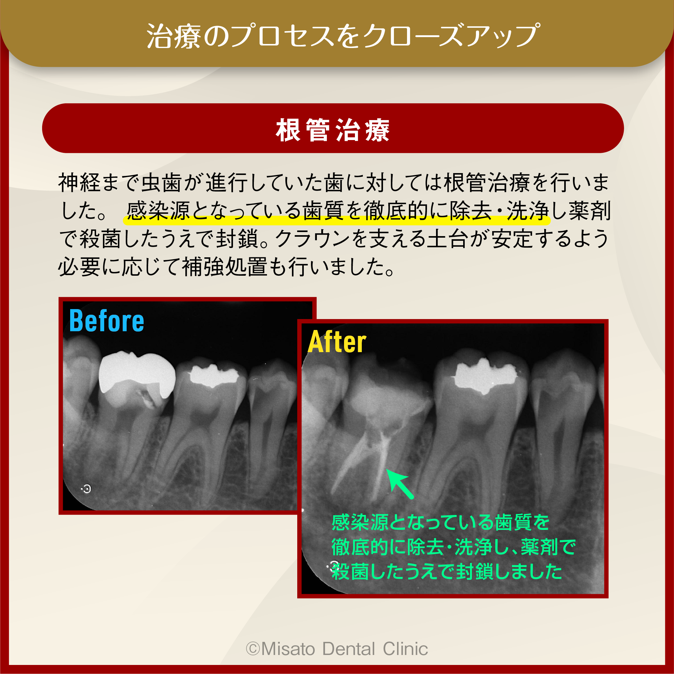 根管治療