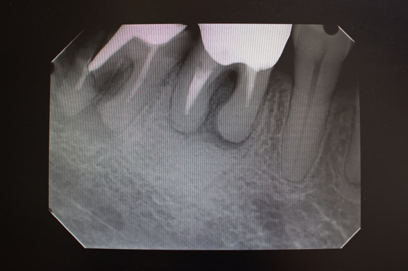 根管治療後のレントゲン写真