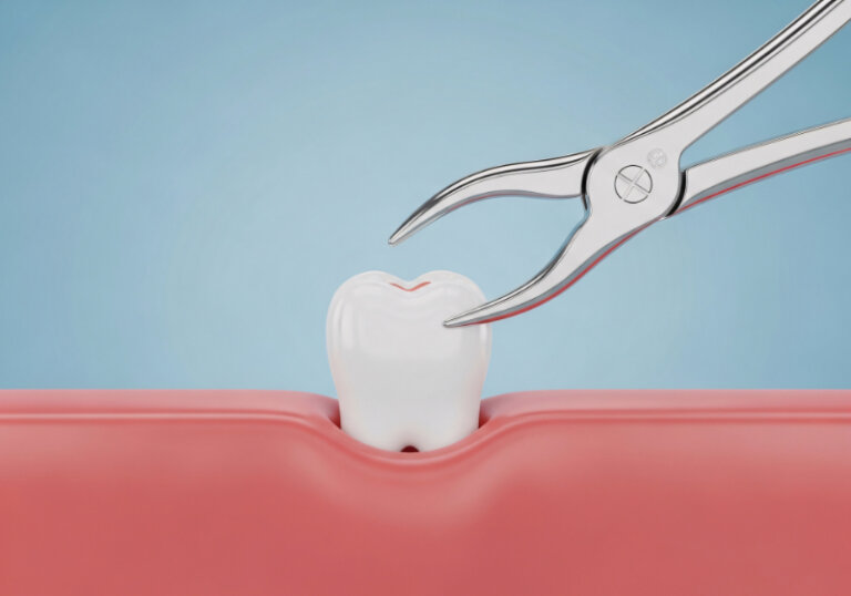 矯正治療で抜歯が必要になる理由とは?抜歯のメリット・デメリットも