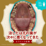 1_「治したはずの歯が次々に悪くなってきた」セラミック症例