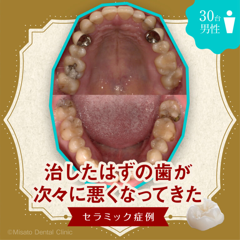 「治したはずの歯が次々に悪くなってきた」セラミック症例