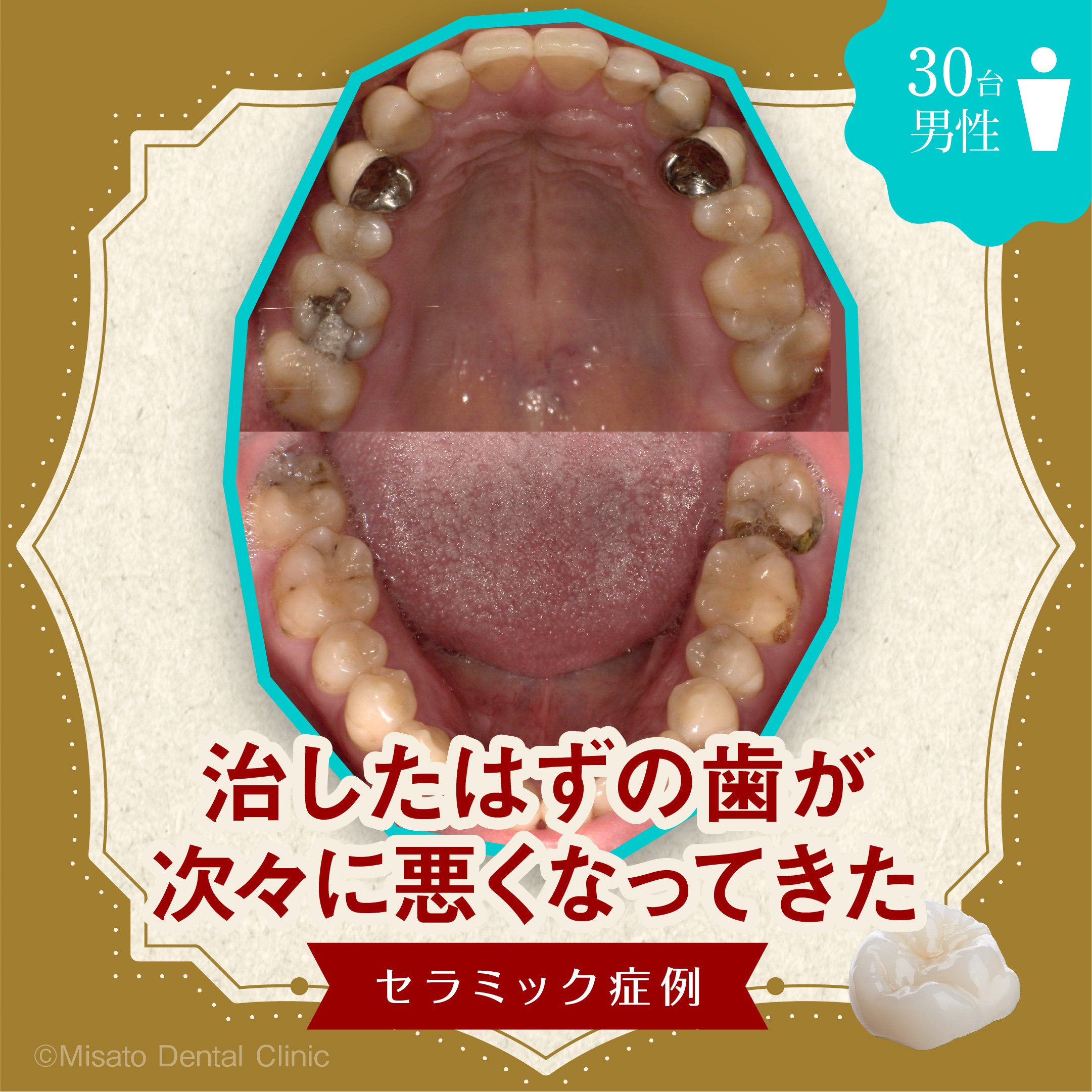 1_「治したはずの歯が次々に悪くなってきた」セラミック症例