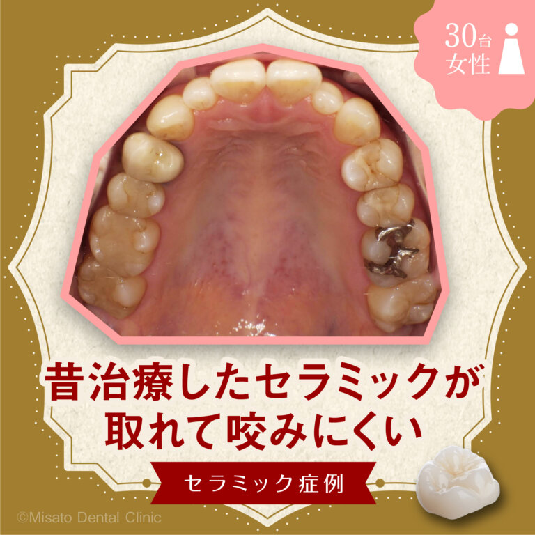 「昔治療したセラミックが取れて咬みにくい」セラミック症例