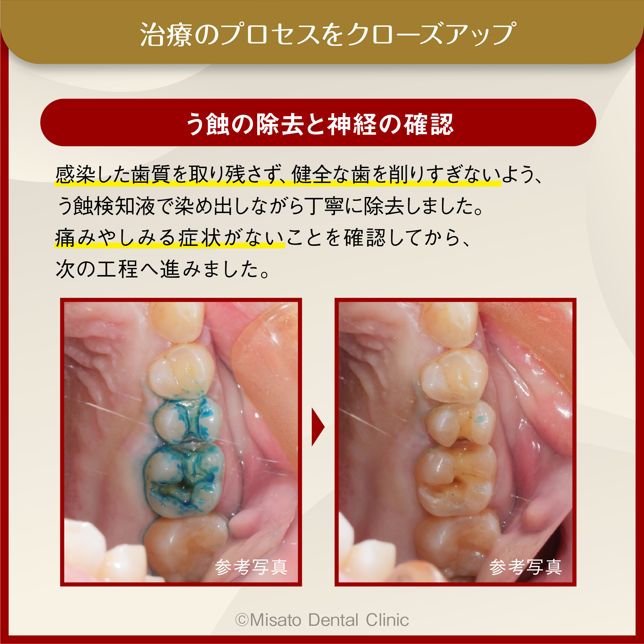 8_う蝕の除去と神経の確認