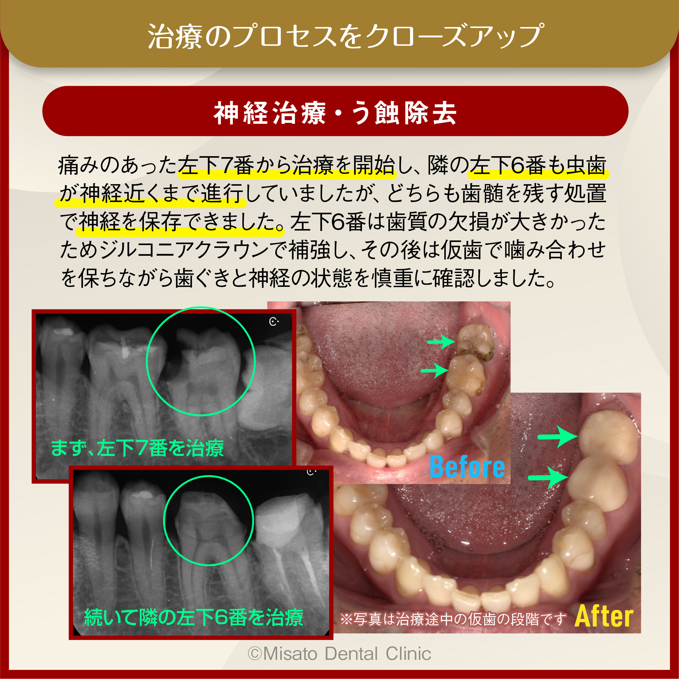 8_神経治療・う蝕除去