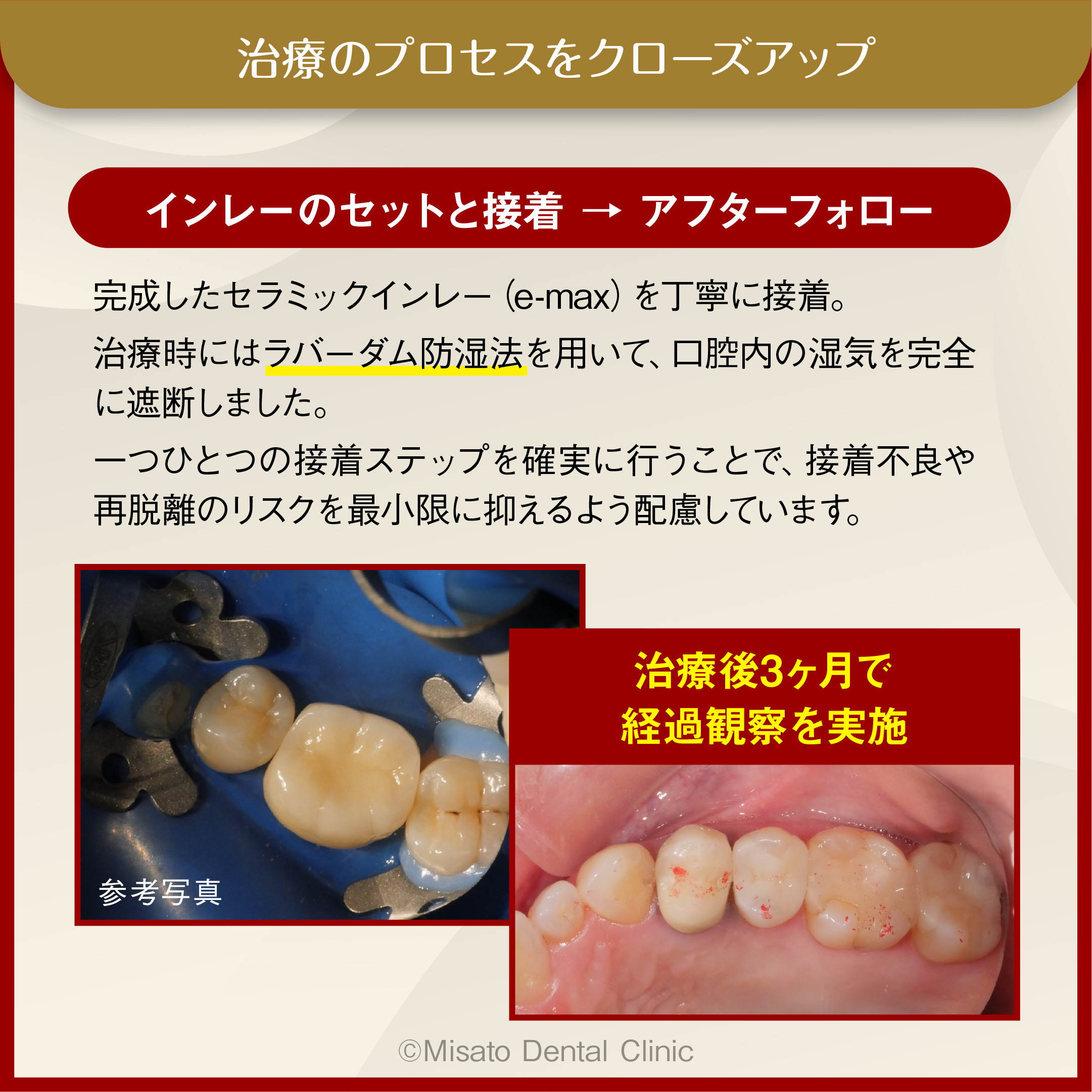 9_インレーのセットと接着 → アフターフォロー