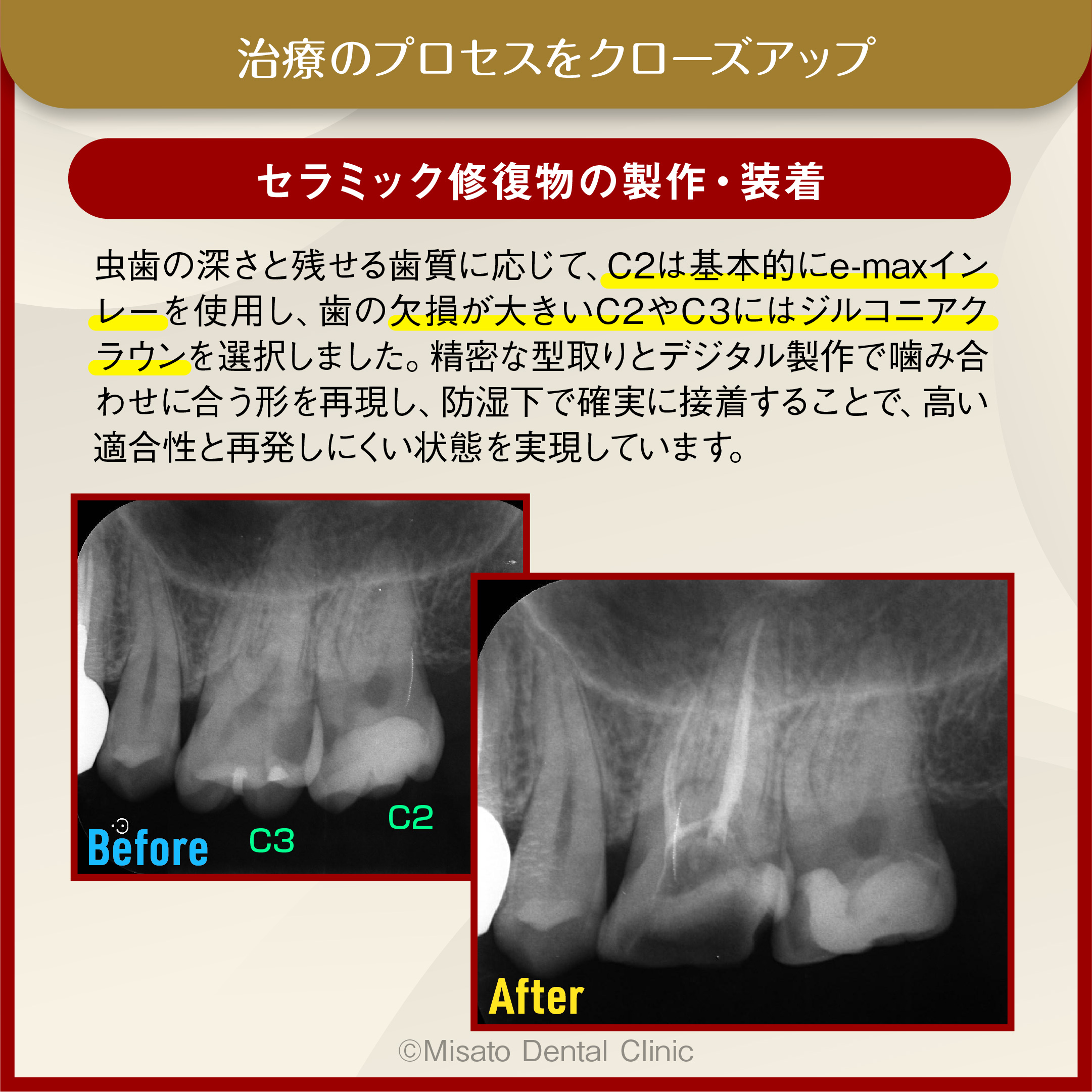 9_セラミック修復物の製作・装着