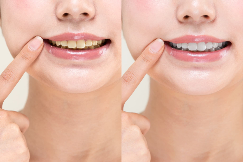 審美歯科のビフォーアフター
