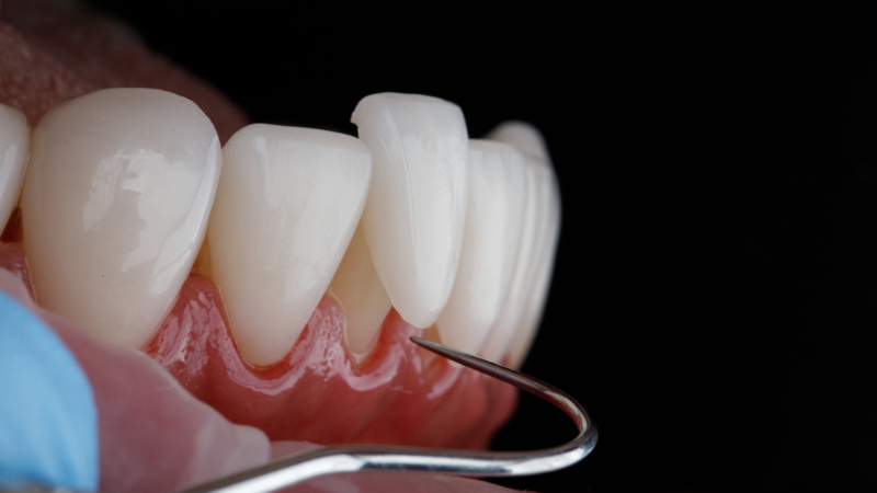 ラミネートべニアを前歯に張り付けているイメージ