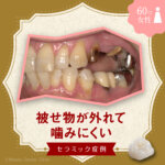 被せ物が外れて噛みにくい